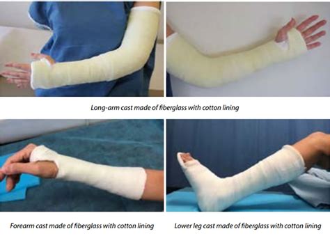 Care of Casts and Splints .